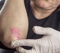 Scientists uncover a key mechanism that protects the skin from harmful inflammation