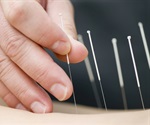Fu's subcutaneous needling offers a safe non-pharmacological therapy for muscle-related pain