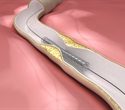Cutting balloon angioplasty proves noninferior to intravascular lithotripsy in treating calcified coronary lesions