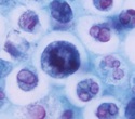 Study offers a potential new strategy to improve treatment responses in multiple myeloma patients