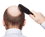 Options for women experiencing hair loss
