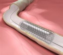 Clinical trial results of drug-eluting stent for peripheral arterial disease presented at LINC 2015