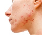 Papules, Pustules and Nodules