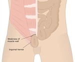Inguinal Hernias in Children