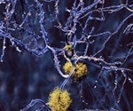 New European initiative aims to transform real world Alzheimer’s disease care