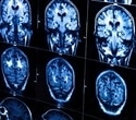 Simple drug treatments could help older brains cope with memory decline and postoperative recovery