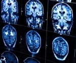 Scientists uncover promising therapeutic target for autoimmune disease affecting the brain