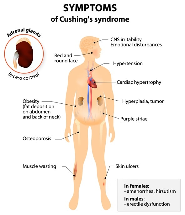 Signs and symptoms of Cushing