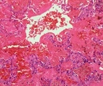 Goodpasture Syndrome