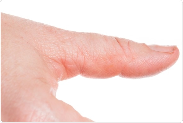 Koilonychia is characterized by spoon-shaped nails. Image Copyright: bmf-foto.de / Shutterstock