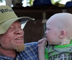 Albinism - Partial Absence of Pigment in the Skin