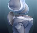 HSS research highlights faster recovery methods after knee surgery