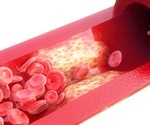 Preventing and Managing Atherosclerosis