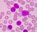 Researchers identify key differences between two subtypes of chronic lymphocytic leukemia