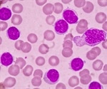 Combination therapy offers hope for ending lifelong chronic lymphocytic leukemia treatment