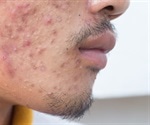 Acne in Men