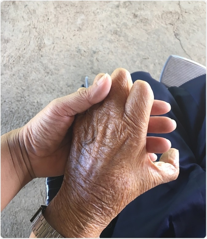 Closeup hands of old man suffering from leprosy, amputated hand. Image Credit: Kritsana Thaweekoon / Shutterstock