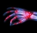 New study reveals silent onset of rheumatoid arthritis