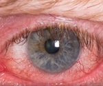 Conjunctivitis Symptoms