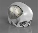 Renishaw to present latest developments in craniomaxillofacial implants at BAOMS