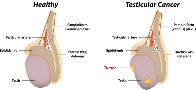 Testicular Cancer - Image Credit: joshya / Shutterstock
