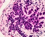 Immune ‘hotspots’ could help predict the risk of breast cancer relapse in patients, study finds