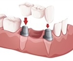 What is a Dental Bridge?