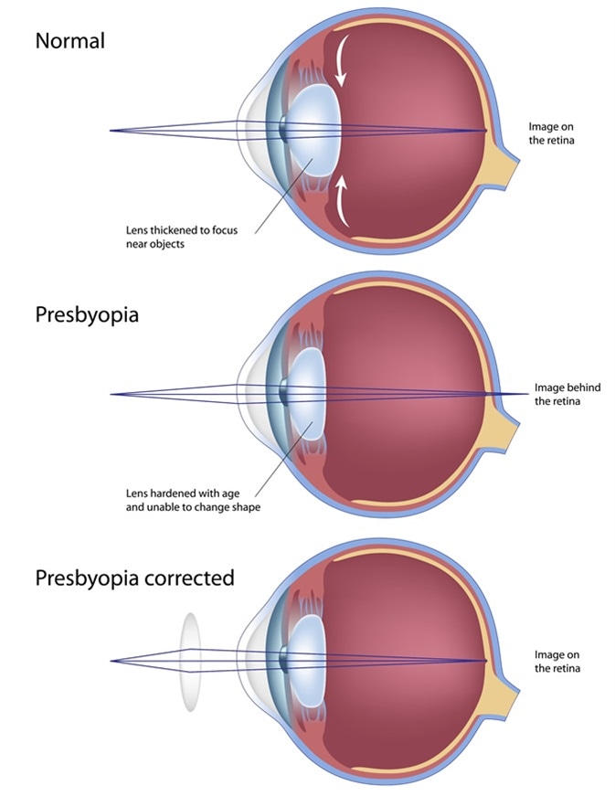 Eye condition Presbyopia. Image Credit: Alila Medical Media / Shutterstock