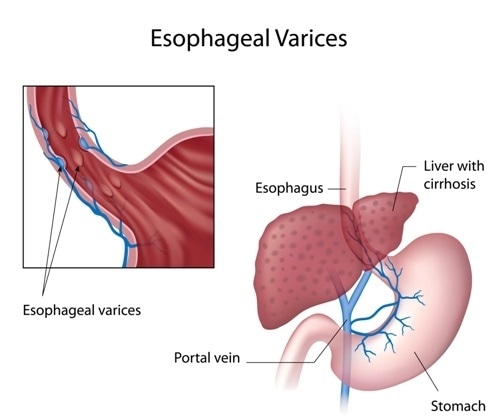 Esophageal varices. Image Credit: Alila Medical Media / Shutterstock