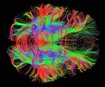 Diffusion Tensor Imaging (DTI) Explained