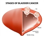 Bladder Cancer Risk Factors