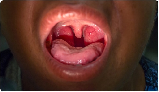 Zooming closeup view of a patient with chronic tonsillitis. Dark frame intentionally for a special aspect of picture. Image Credit: Karan Bunjean / Shutterstock