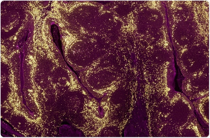 A tumour sample where the levels of different proteins in cell populations have been identified using a fluorescently labelled antibody - By Carl Dupont