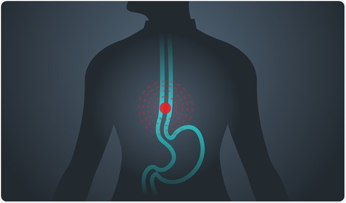 Diagram of man with esophageal cancer