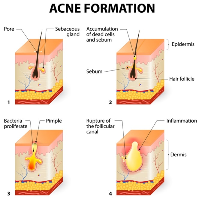 Formation of skin acne or pimple. The sebum in the clogged pore promotes the growth of a certain bacteria (Propionibacterium Acnes). This leads to the redness and inflammation associated with pimples. Image Credit: Designua / Shutterstock