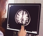 Neck scan detects dementia way before symptoms appear