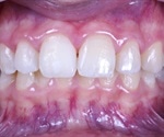 What is Tooth Remineralization?