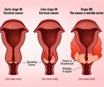 Minimally invasive surgery for cervical cancer may not be a good idea finds a pair of studies
