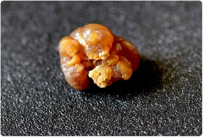 Nephrolithiasis - Closeup shot of a kidney stone (renal calculus or nephrolith) on black background. Image Credit: AjayTvm / Shutterstock