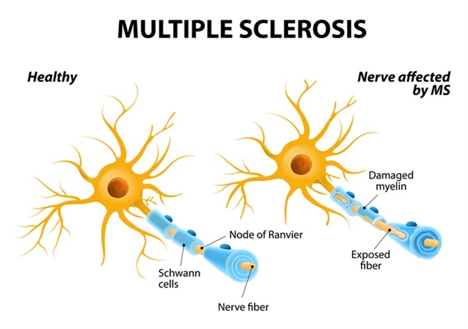 Multiple sclerosis or MS. autoimmune disease. the nerves of the brain and spinal cord are damaged by one