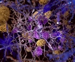 Zileuton can help reduce amyloid plaque formation and Alzheimer's development