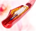 Landmark trial shows drug-eluting balloon as effective option for in-stent restenosis