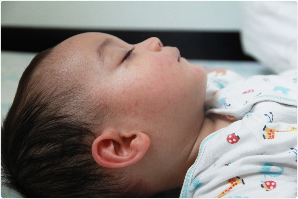Child with Early Infantile Epileptic Encephalopathy (EIEE)