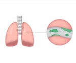 Bronchiectasis Complications