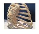 Stratasys advanced FDM 3D printing helps Biodonostia to improve treatment for thoracic wall tumors