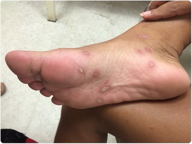 Secondary Syphilis of feet. Image Credit: TisforThan / Shutterstock