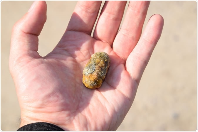 Gallstone / Gall bladder stone. Image Credit: eleonimages / Shutterstock