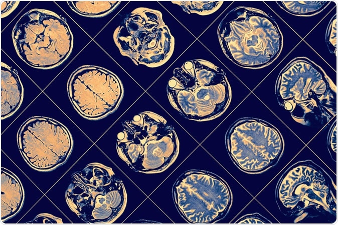 MR image of human brain. Image Credit: sfam_photo / Shutterstock