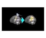 Brain stimulation increases functional connectivity of memory network