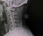 What is Cervical Spondylosis?